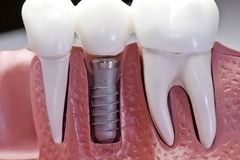 Dental Implants